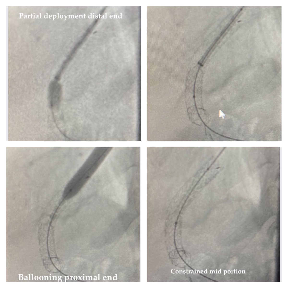 Ambarish Bhat (@bhat_ambarish) on Twitter photo TIPS reduction neat technique! Unsheath distal end of VBX➡️deploy the distal end ➡️withdraw balloon➡️Unsheath rest of the stent➡️Balloon the proximal end➡️measure pressure. Pre 9 post 18. <a href="/SIRspecialists/">Society of Interventional Radiology</a> <a href="/RyanMDavis2/">Ryan M Davis</a> <a href="/w_bryan52/">wbryan</a> <a href="/rakeshkvarma/">Rakesh Varma</a> <a href="/ISVIRIndia/">ISVIR India</a> <a href="/CAIRweb/">Canadian Association for Interventional Radiology</a> <a href="/SIRRFS/">SIR RFS</a> <a href="/SIR_ECS/">SIR ECS</a> TIPS reduction neat technique! Unsheath distal end of VBX➡️deploy the distal end ➡️withdraw balloon➡️Unsheath rest of the stent➡️Balloon the proximal end➡️measure pressure. Pre 9 post 18. <a href="/SIRspecialists/">Society of Interventional Radiology</a> <a href="/RyanMDavis2/">Ryan M Davis</a> <a href="/w_bryan52/">wbryan</a> <a href="/rakeshkvarma/">Rakesh Varma</a> <a href="/ISVIRIndia/">ISVIR India</a> <a href="/CAIRweb/">Canadian Association for Interventional Radiology</a> <a href="/SIRRFS/">SIR RFS</a> <a href="/SIR_ECS/">SIR ECS</a>