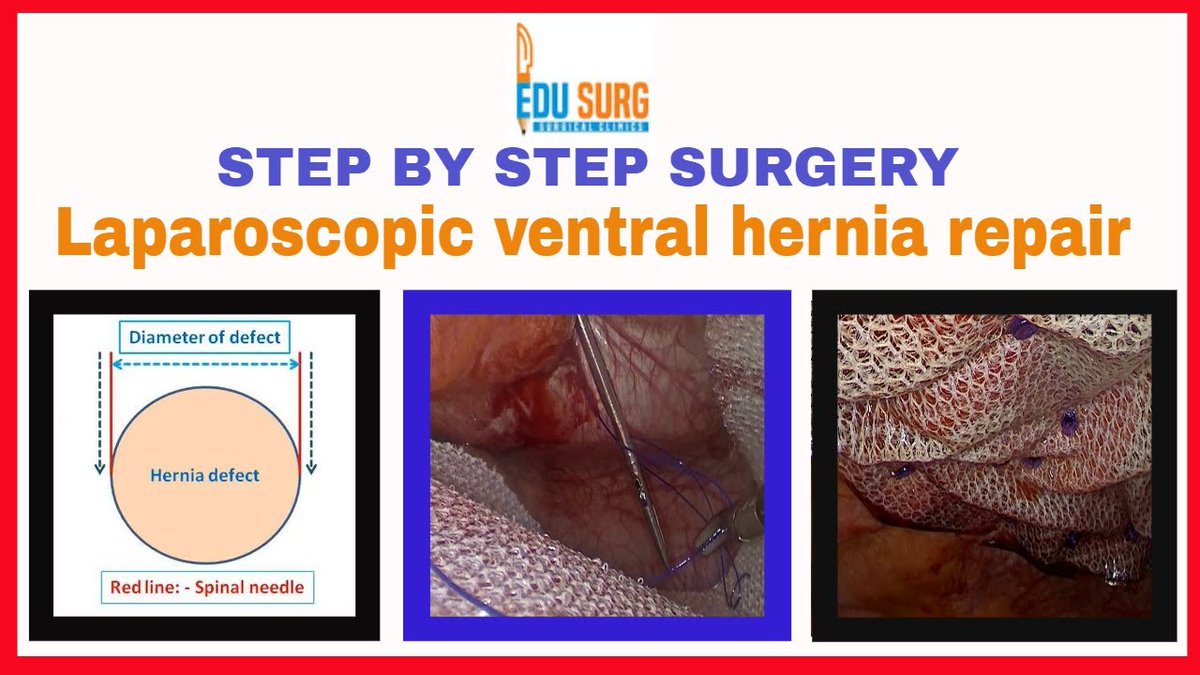 edusurg_clinics's tweet photo. Ventral Hernia repair - Minimally invasive step by step IPOM repair technique. Click here to watch the full Video: https://t.co/99tjnExlNa
#hernia #VentralHernia #VentralHerniaRepair #HerniaSurgery #IPOMRepair #MinimallyInvasiveSurgery #Surgery #elearning #EduSurgClinics https://t.co/QMoIE2Q3Z6