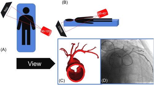 gbiondizoccai's tweet photo. Welcome to the '“Reverse Spider View” for left stem coronary artery angiographic evaluation', courtesy of Rigatelli et al
https://t.co/soex3bagJP
@ccijournal https://t.co/z3MaN1z09p