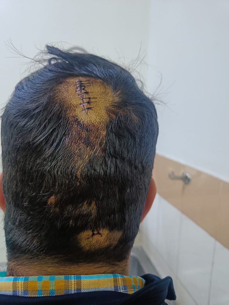 JournoMeenu's tweet photo. ग्रेटर नोएडा बीटा २ थाने का मामला, जहां कपड़ा व्यापारी के सर पर लोहे की रॉड से वार हुआ और उसे 10 गहरे टांके आए, इसके बावजूद भी नोएडा पुलिस ने उस अपराधी पर सिर्फ छोटी सी धारा लगाकर छोड़ दिया है। पुलिस कमिश्नर को इस पर एक्शन लेना चाहिए। @Uppolice
@dgpup @noidapolice @CP_Noida https://t.co/qSgJvVF8v2