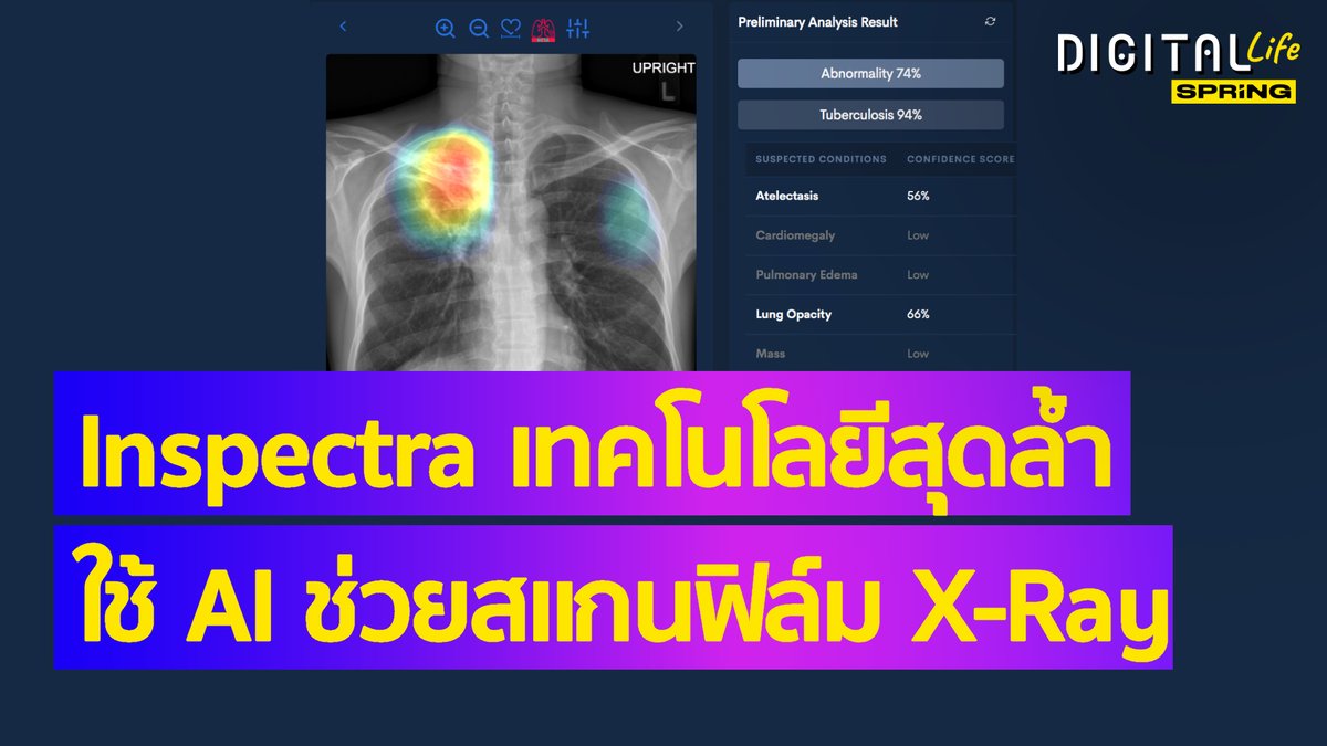 SPRiNGNEWS_TH's tweet photo. เทคโนโลยีการแพทย์ไทยสุดล้ำ!
ใช้ AI ช่วยอ่านฟิล์มเอ็กซ์เรย์ให้ง่ายขึ้น
#SPRiNG #SPRiNGnews #Inspectra #ระบบปัญญาประดิษฐ์ #Perceptra https://t.co/kcgWIBj8Hi