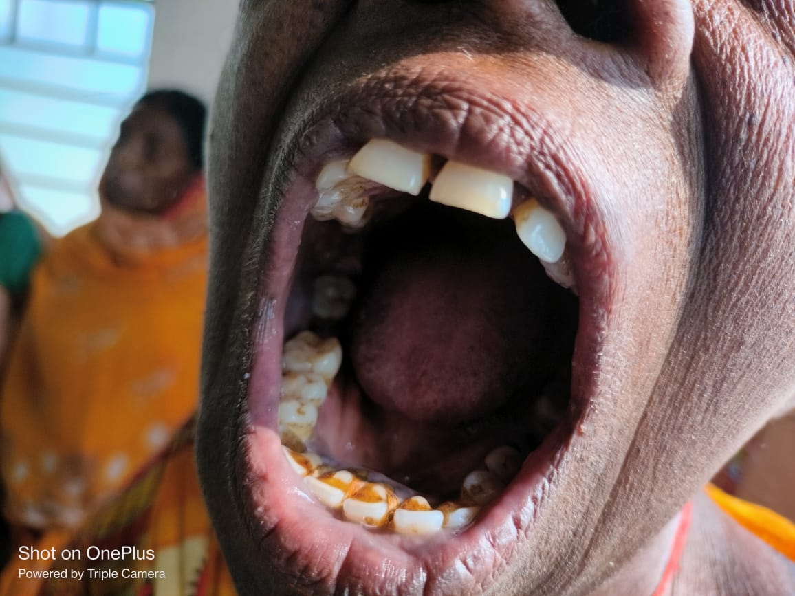 kodermaCHOHWCw1's tweet photo. #oralscreening
#ncdscreening
#oralhealtheducation
@kodermaCHOHWC
@BannaGupta76 https://t.co/VXpVscobfT