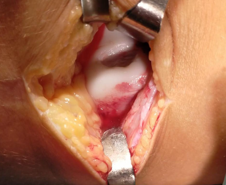 iccimplanteC's tweet photo. 📋Paciente 12 años:
⚽Jugando al fútbol nota dolor y crujido tras un giro
🩻RM: lesión condral desprendida en tróclea femoral externa
🥼Fijación de fragmento y toma de biopsia de cartílago 🧫#preICC por si el fragmento no se incorpora

👩🏻‍⚕️Vía @DraIsaGuillen - @ClinicaCEMTRO https://t.co/YuMGkUkaaq