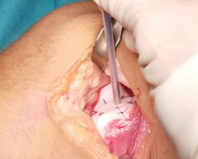iccimplanteC's tweet photo. 📋Paciente 12 años:
⚽Jugando al fútbol nota dolor y crujido tras un giro
🩻RM: lesión condral desprendida en tróclea femoral externa
🥼Fijación de fragmento y toma de biopsia de cartílago 🧫#preICC por si el fragmento no se incorpora

👩🏻‍⚕️Vía @DraIsaGuillen - @ClinicaCEMTRO https://t.co/YuMGkUkaaq