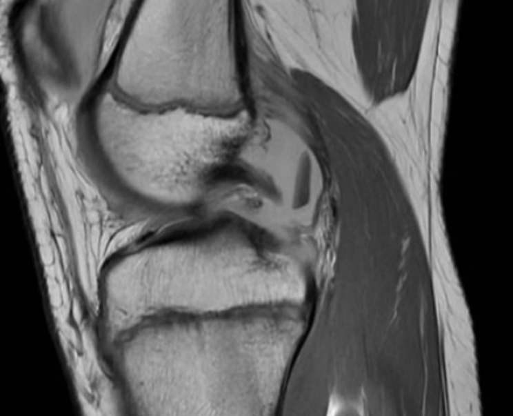 iccimplanteC's tweet photo. 📋Paciente 12 años:
⚽Jugando al fútbol nota dolor y crujido tras un giro
🩻RM: lesión condral desprendida en tróclea femoral externa
🥼Fijación de fragmento y toma de biopsia de cartílago 🧫#preICC por si el fragmento no se incorpora

👩🏻‍⚕️Vía @DraIsaGuillen - @ClinicaCEMTRO https://t.co/YuMGkUkaaq