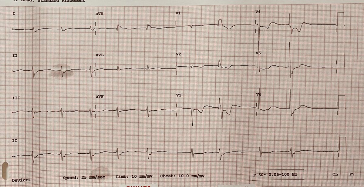 ECG for discussion. 60 year male with history of dizziness , no h/o htn or diabetes. No other medications taken @Sam_ChiramelEp @MuhammadAmeenC @syamkumarmd @UlhasDr