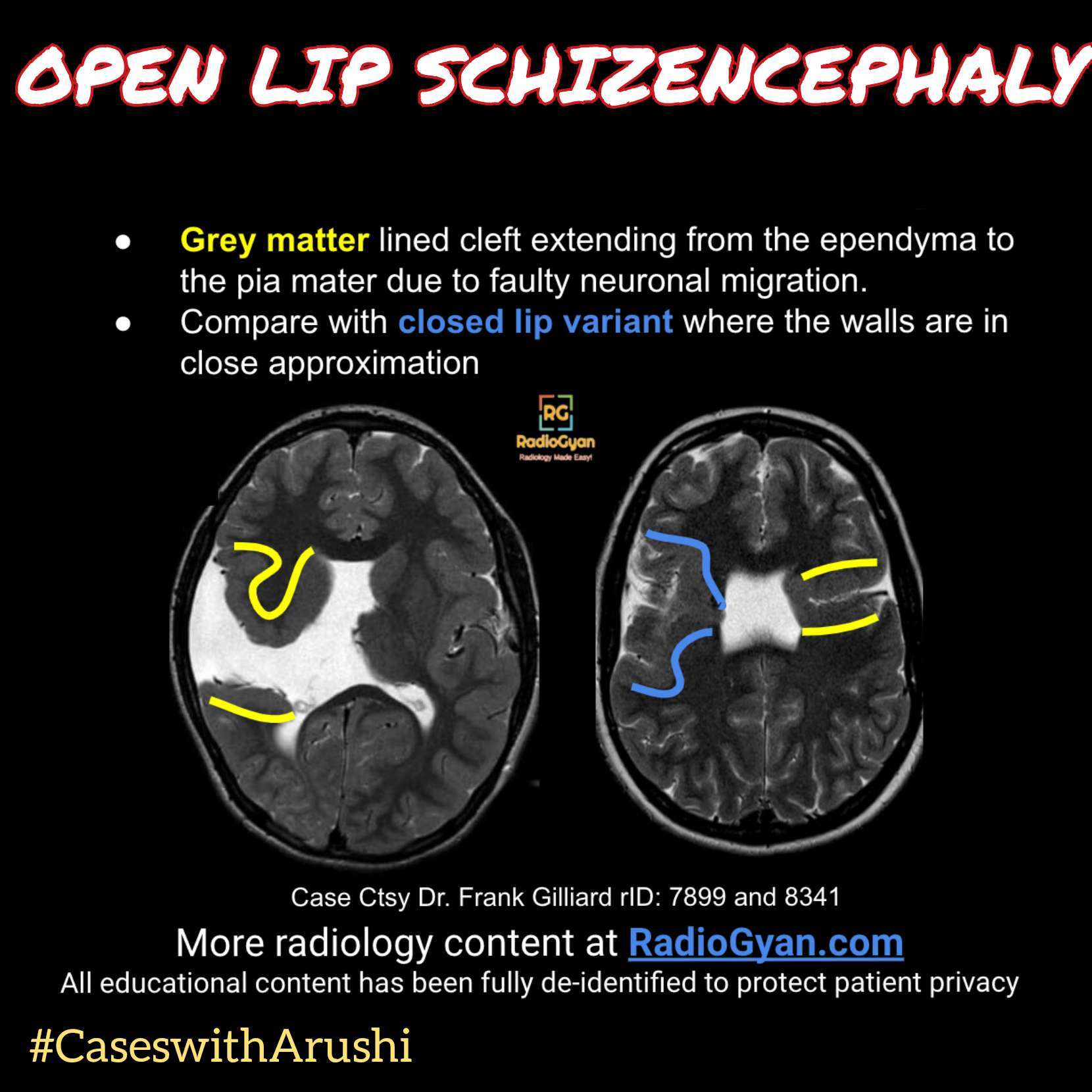 schizencephaly-ultrasound