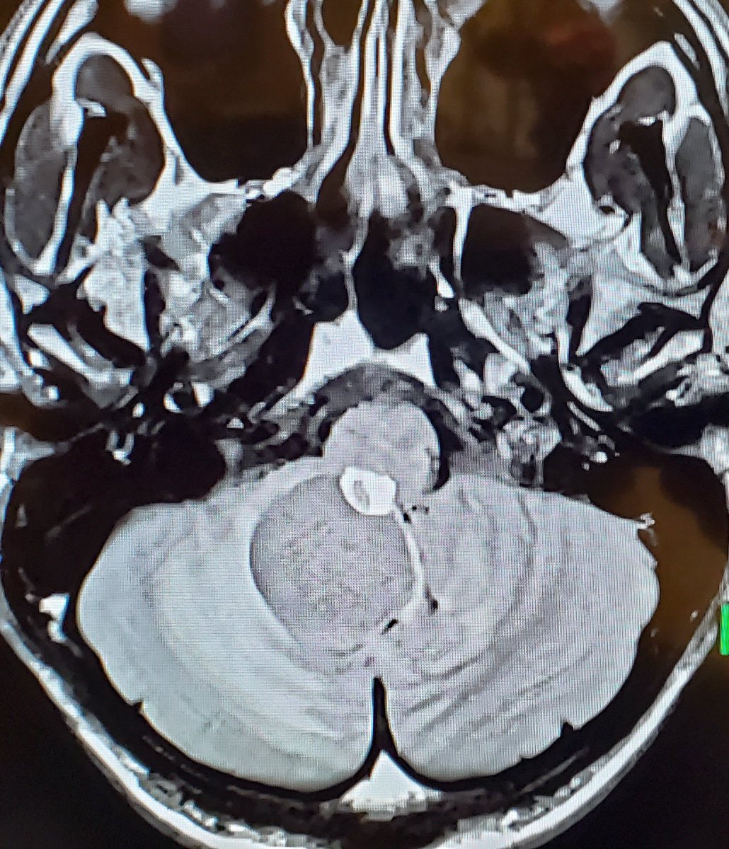 Christmas day surgery! Headaches, nausea, gait ataxia in a young patient who can't wait for 2023! #braintumor #litbrain @PennNSG Thank you to the wonderful team who made it smooth this am. @sm_hemanackah, Brenna, Grace, Mercedes (monitoring)