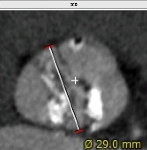 MosaAbbadi1's tweet photo. 75y♂️, severe type 0 BAV stenosis, perimeter 27.2,area570. Evolute 34 with predi and post 25mm🎈and #cusp_overlap #commisural_alignment
Shallow implant with coronary access. Trace AI, No ECG changes, MPG5 https://t.co/NhSHCeE5xi