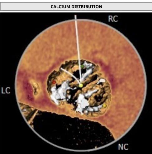 MosaAbbadi1's tweet photo. 75y♂️, severe type 0 BAV stenosis, perimeter 27.2,area570. Evolute 34 with predi and post 25mm🎈and #cusp_overlap #commisural_alignment
Shallow implant with coronary access. Trace AI, No ECG changes, MPG5 https://t.co/NhSHCeE5xi