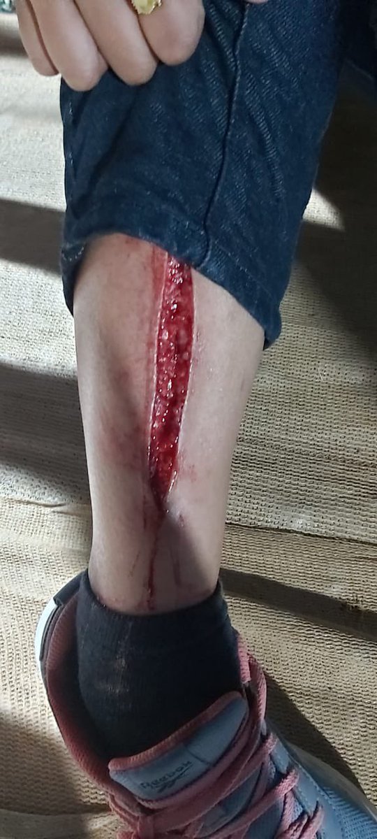 Sarafprasang's tweet photo. @arijitsingh look what the mismanagement at the Ahmedabad concert has caused us! A friend is going under a surgery right now due to poor management. Zero support from the crew, post this disastrous incident. @GypsyEvents @IndiaToday #ArijitSinghLive https://t.co/xFMCij7fku
