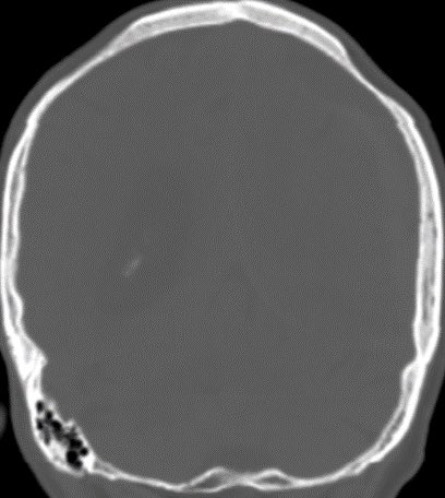 Daniel Gewolb, MD (@daniel_gewolb) on Twitter photo CT shows thinning of the bilateral parietal bones in this 70 y/o F.
Dx: Biparietal Osteodystrophy
This is an uncommon, benign incidental finding thought to be related to osteoporosis. Know the appearance as it occasionally comes up on board exams
#radres #NeuroRad <a href="/TheASNR/">The American Society of Neuroradiology</a> CT shows thinning of the bilateral parietal bones in this 70 y/o F.
Dx: Biparietal Osteodystrophy
This is an uncommon, benign incidental finding thought to be related to osteoporosis. Know the appearance as it occasionally comes up on board exams
#radres #NeuroRad <a href="/TheASNR/">The American Society of Neuroradiology</a>