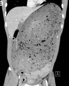 Quand t’aurais pas dû reprendre de la bûche: