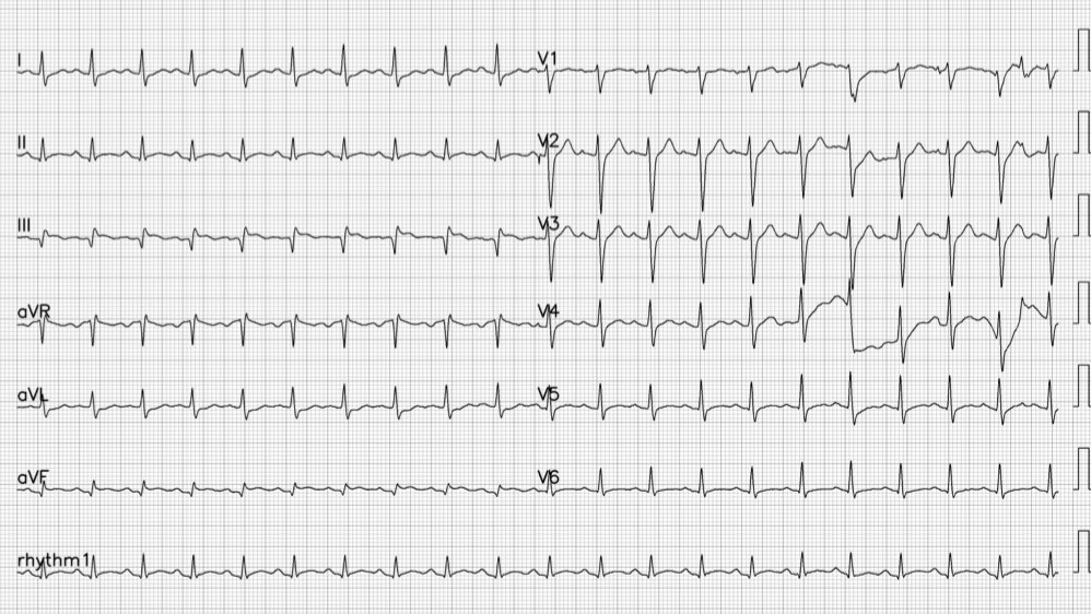 cardioparis's tweet photo. A good one for @smithECGBlog. A young 39 y-o patient with diabetes from pakistan presenting to the ED with left arm acute pain since 3 hours. What do you think ? 🔍🔍🔍#CardioEd #Cardiotwitter https://t.co/ZHLwQt9OZp