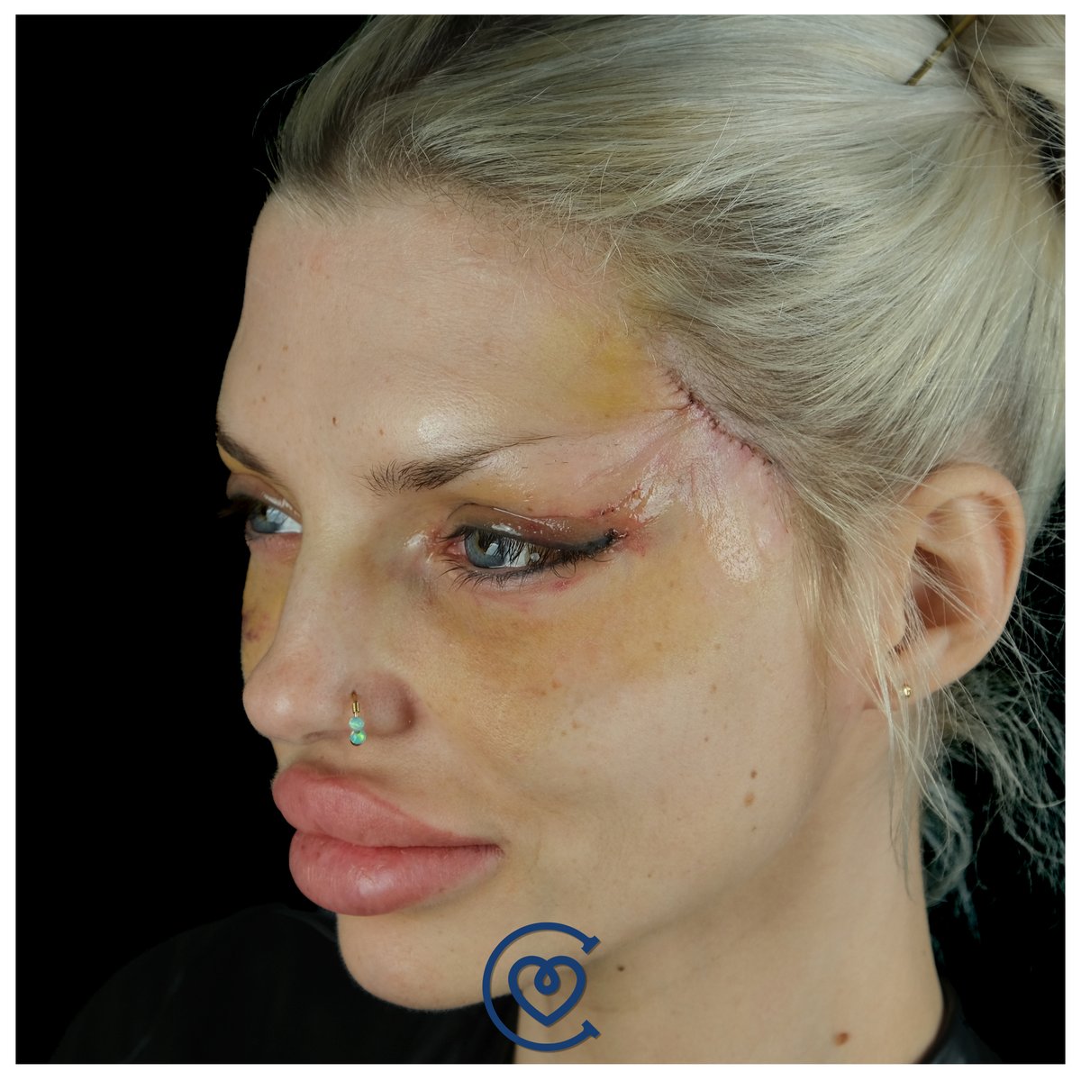 CayraClinic's tweet photo. Our guest Anna came from Germany for cat eye surgery and endoscopic temple lift.#cateyesurgery #catsofinstagram #eyes #plasticsurgery #temporalfacelift method ๐
#temporallift #cheeklift #lowerblepharoplasty #browlift #cateyessurgery #cateyesurgery #foxeyes #foxeyessurgery https://t.co/wfasjxF8nN