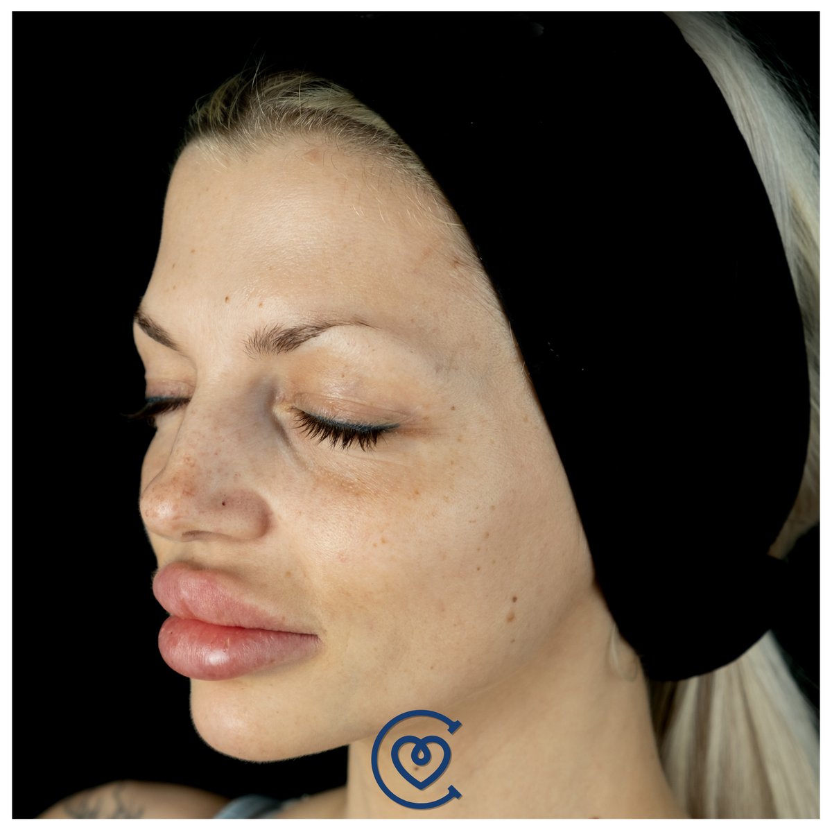 CayraClinic's tweet photo. Our guest Anna came from Germany for cat eye surgery and endoscopic temple lift.#cateyesurgery #catsofinstagram #eyes #plasticsurgery #temporalfacelift method ๐
#temporallift #cheeklift #lowerblepharoplasty #browlift #cateyessurgery #cateyesurgery #foxeyes #foxeyessurgery https://t.co/wfasjxF8nN