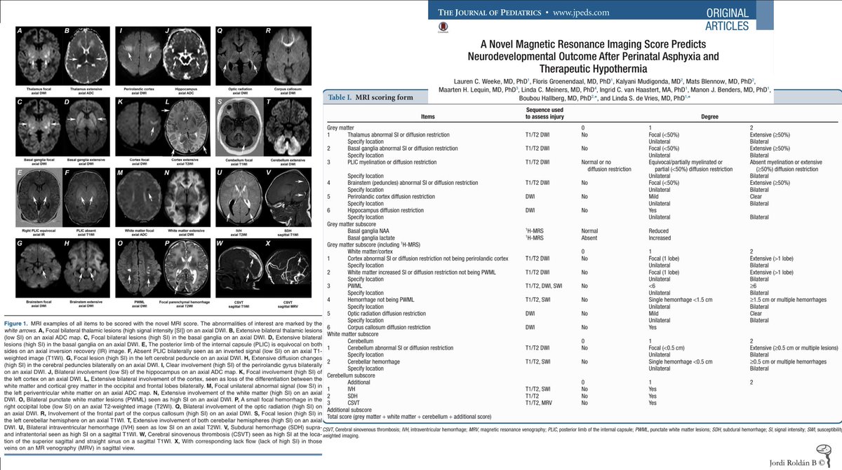 JordiRoldanB's tweet photo. #OnePediNeuroRad 🌏  #Neurotools 
📌MR scoring sistems in Hypoxic Ischemic Encephalopathy

1️⃣AJ. Barkovich 1998
https://t.co/UubSoR0MUq
2️⃣S. Shankaran 2012
https://t.co/3SxLc5SIsP
3️⃣LC. Weeke 2018
https://t.co/YfeETVxrb5

✅ 3 scores evaluation 2022
https://t.co/4dct04rlLD https://t.co/uF6FUqLDbr