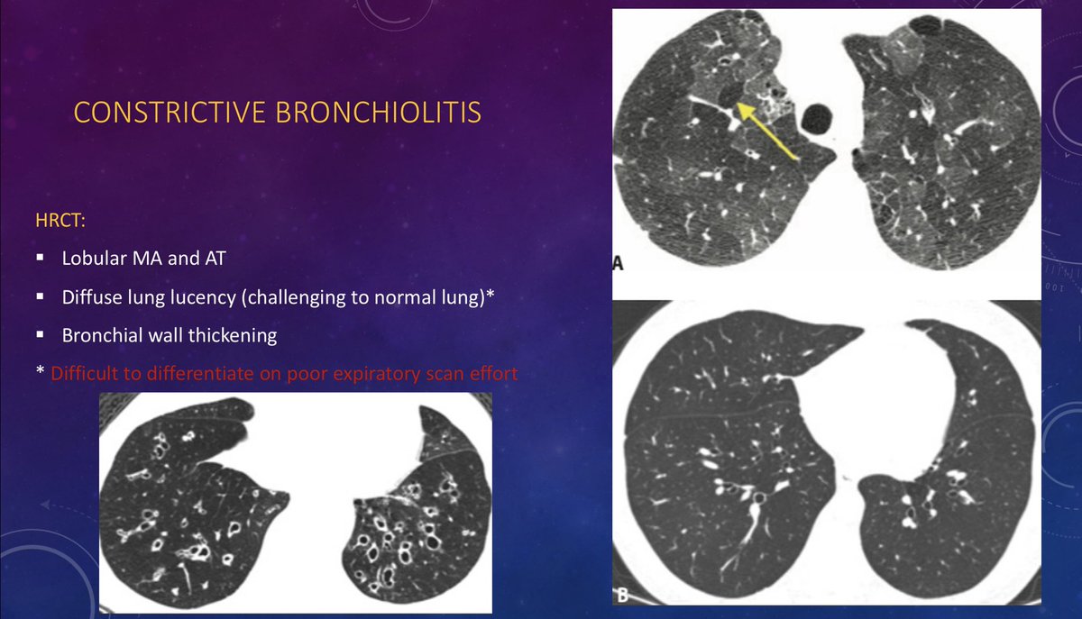 Dr Khaled Ahmed Abuzeid on Twitter "Mosaic attenuation MA due to