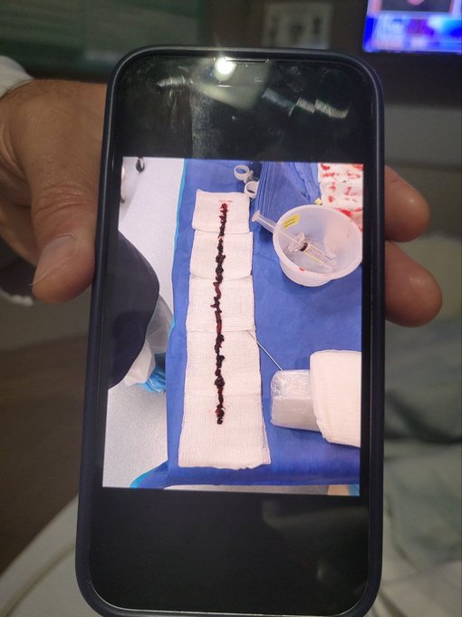Coágulo sanguíneo de 22 cm retirado de uma pessoa viva, "vacinada". Impressionante o que esse maldito veneno provoca.