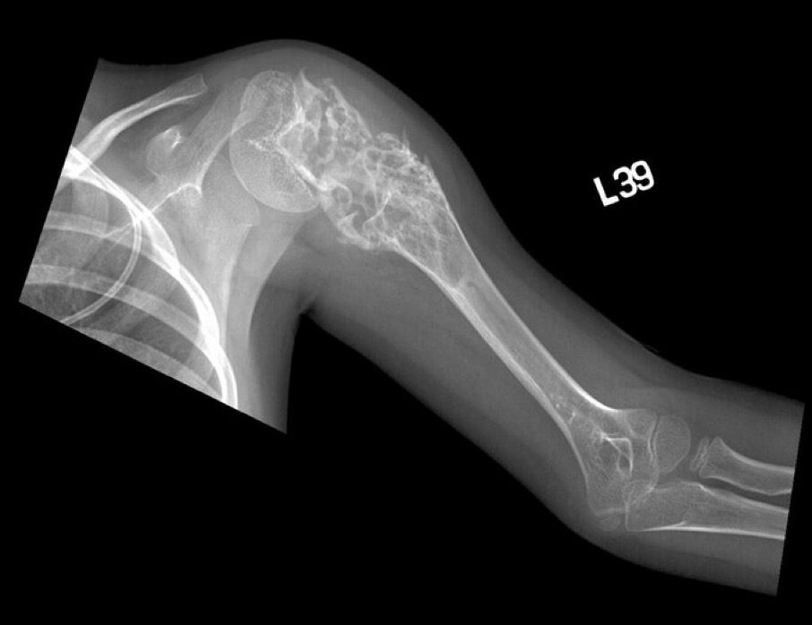 Brown Hospital Medicine on Twitter "A 6 year old girl presented with