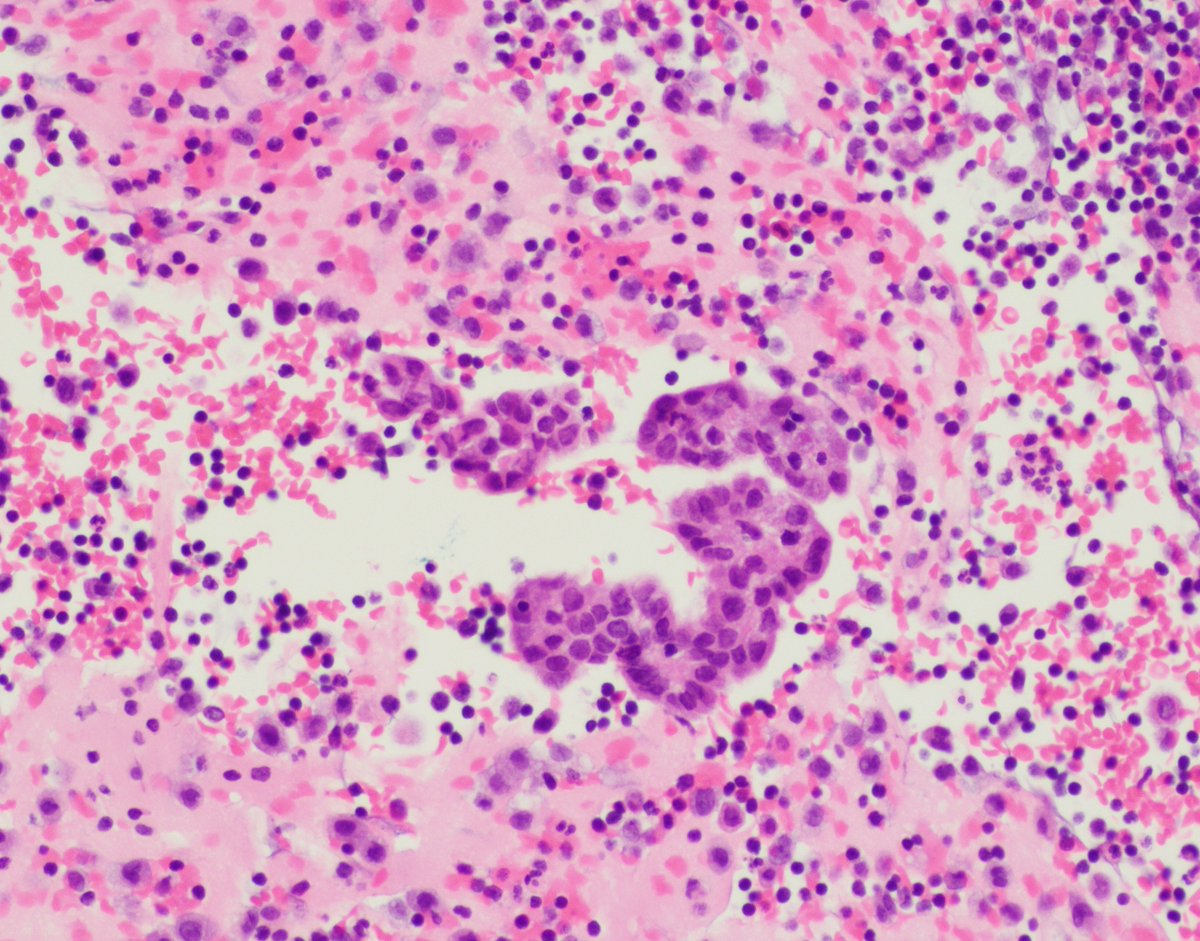 SunyUpstate's tweet photo. 50-year-old man with ascites and past medical history of abdominal malignancy. What is your diagnosis? What stains might you order? #cytopathology #cytology #PathTwitter https://t.co/Jo08HUi9xm