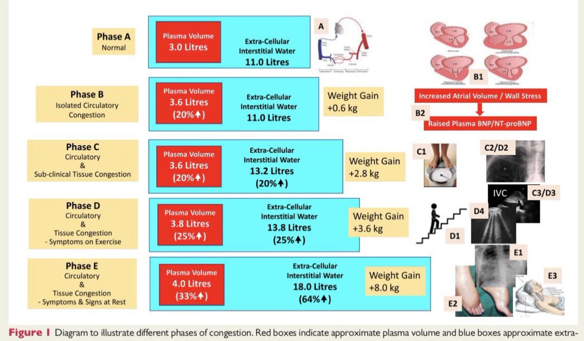 GiuseppeGalati_'s tweet photo. @AndreasGevaert @hvanspall @FZores @MKIttlesonMD @JJheart_doc @BirkhoelzerS Look for congestion despite symptoms.
Accordingly to the #UniversalDefinition of #HF (signs & / or symptoms).
Personally I look also for subclinical congestion (by using Bioelectrical impedance vector analysis : BIVA) & if the answer is yes go for quadruple therapy @gcfmd https://t.co/Q1gYBJNGGe