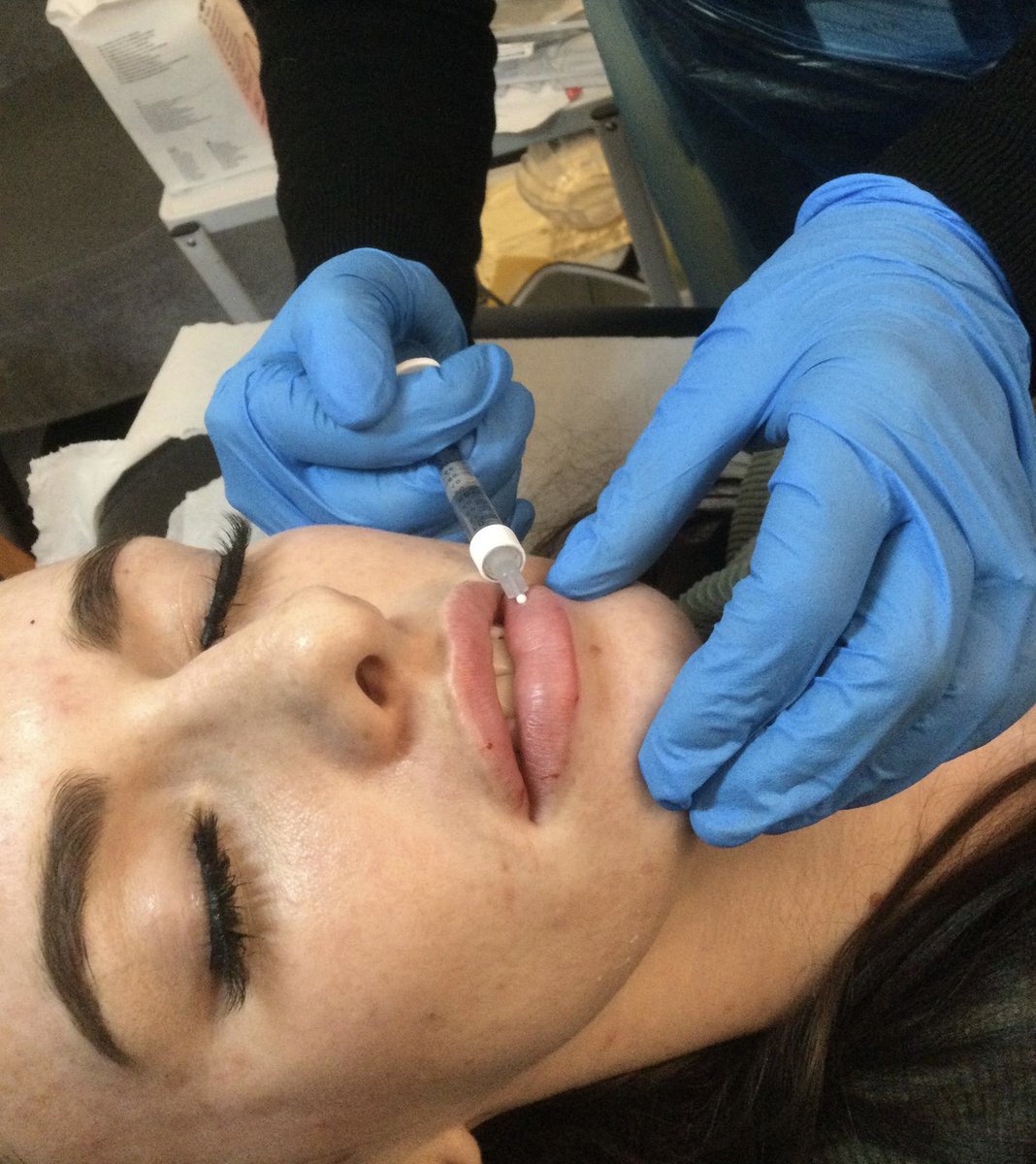 Aesthe1Complete's tweet photo. Beautiful full lips today. #lipsfillers #fillers #aylesbury #UK #completeaesthetics #Juvederm https://t.co/sve6tc7j2s