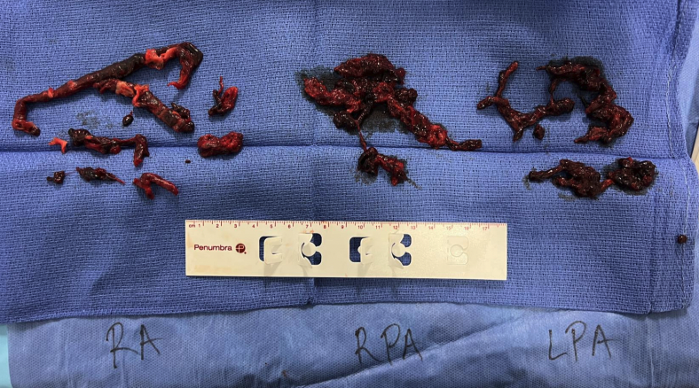 RapidAI's tweet photo. Clot photos ahead!
Clinical case from @JayMathewsMD using #RapidAI workflow to treat a severe case of #pulmonaryembolism: 
🫁 Severe dyspnea for over 2 days
🫁 Severe right lower extremity swelling with extensive iliofemoral DVT
🫁 Echo shows CIT- subsequent CTA with extensive PE https://t.co/M6gzvASfH1