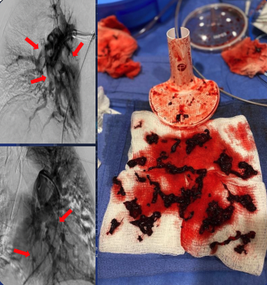 RapidAI's tweet photo. Clot photos ahead!
Clinical case from @JayMathewsMD using #RapidAI workflow to treat a severe case of #pulmonaryembolism: 
🫁 Severe dyspnea for over 2 days
🫁 Severe right lower extremity swelling with extensive iliofemoral DVT
🫁 Echo shows CIT- subsequent CTA with extensive PE https://t.co/M6gzvASfH1
