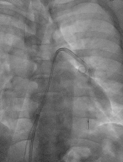 RapidAI's tweet photo. Clot photos ahead!
Clinical case from @JayMathewsMD using #RapidAI workflow to treat a severe case of #pulmonaryembolism: 
🫁 Severe dyspnea for over 2 days
🫁 Severe right lower extremity swelling with extensive iliofemoral DVT
🫁 Echo shows CIT- subsequent CTA with extensive PE https://t.co/M6gzvASfH1
