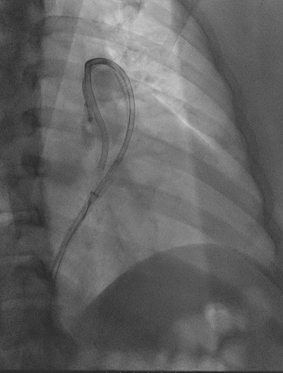 RapidAI's tweet photo. Clot photos ahead!
Clinical case from @JayMathewsMD using #RapidAI workflow to treat a severe case of #pulmonaryembolism: 
🫁 Severe dyspnea for over 2 days
🫁 Severe right lower extremity swelling with extensive iliofemoral DVT
🫁 Echo shows CIT- subsequent CTA with extensive PE https://t.co/M6gzvASfH1