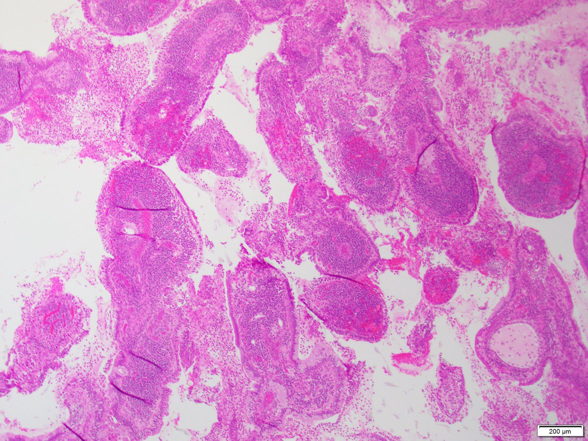 leon_metlay's tweet photo. Incidental bx of "cervical ectropion", noted during D&amp;S of missed abortion. My first encounter with this entity. #GynPath 
X4 and x10 https://t.co/i8c6vWv957
