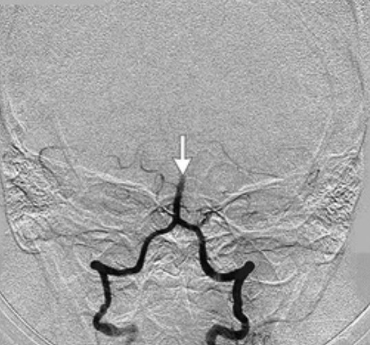 Oren Gottfried, MD on Twitter "43 year old woman with impaired