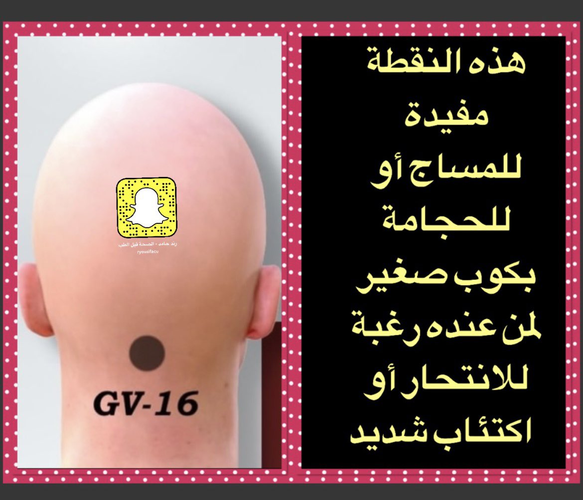 نقاط الحجامة المهمة للتوعية وهي هذه النقطة السوداء تكون مع مستوى خط الشعر