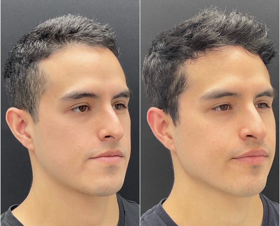 The Cosmetic Lane on X: "Balancing the face with double jaw surgery,  genioplasty & facial asymmetry correction ✨ https://t.co/3ITdgkFso4" / X