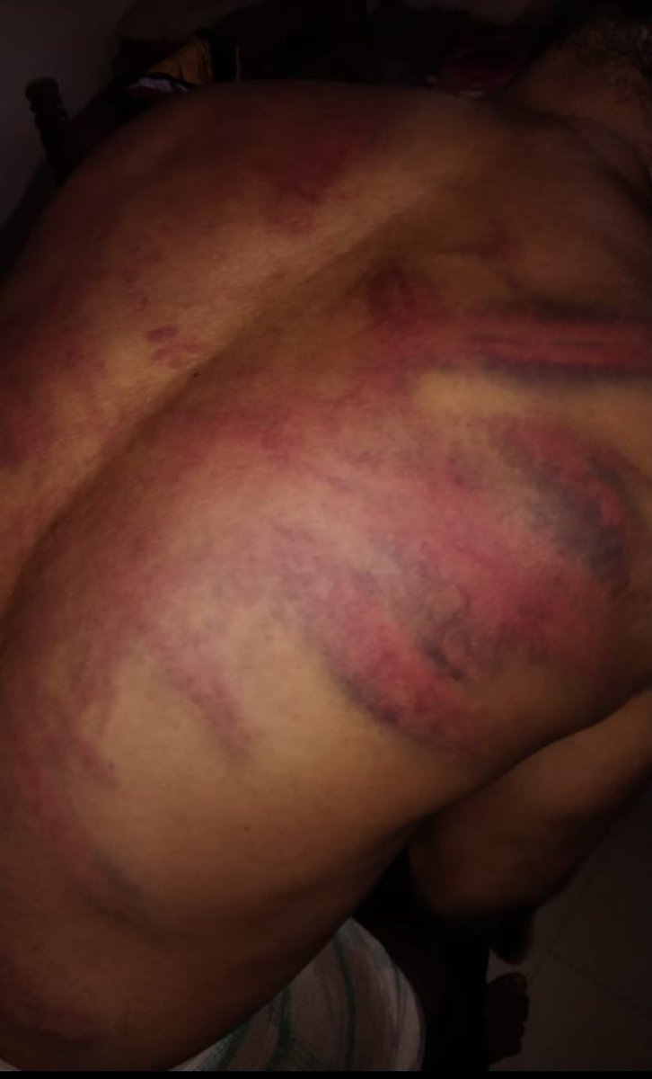 Shaad_Bajpe's tweet photo. #Mangalore: In a shocking incident that happened near Raayi of Bantwal Taluk, Ishak(45) a resident of Mullarapatna has been brutally assaulted allegedly by Sanghparivar members creating fake accusations.
He was traveling in 'Maha Ganesh' private bus enroute to Moodbidri.
1/n https://t.co/ggKXvN8HmF