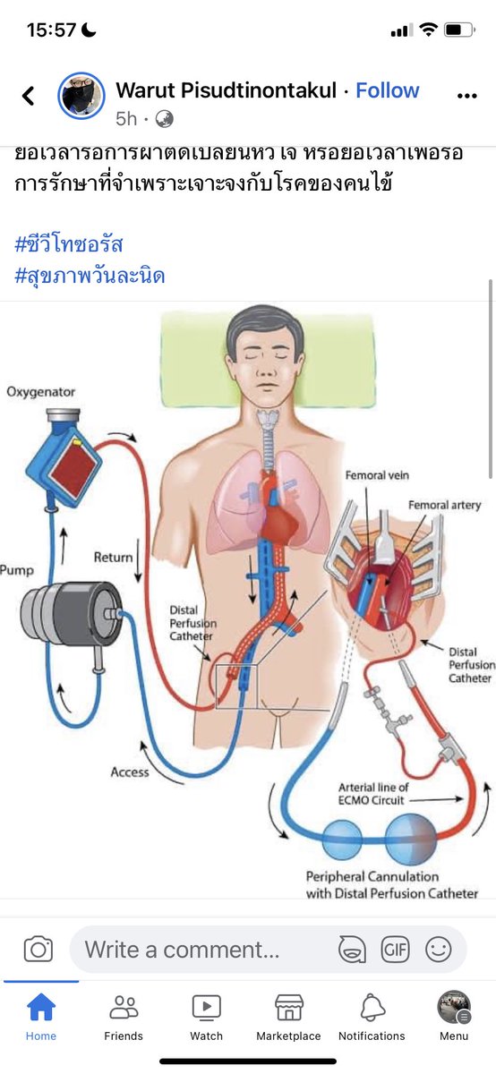 aorwiki's tweet photo. ใน #ข่าวลือ นั้น พูดถึง ECMO  นี่เลยไปเสือกมา การเสือกที่มีคุณภาพ เราต้องเอ้ดดูเขตไปด้วย https://t.co/3moC3y5N4D