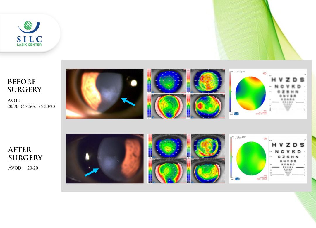 SILCLASIKCENTER's tweet photo. One of smartsurface surgery case at SILC Lasik Center:
A 23-year-old, woman, with #astigmatism #myopia have had #lasik surgery was #TransPRK #surfaceablation which name #smartsurface from #schwind.laser in #silclasikcenter
For further information, Instagram @silclasikcenter https://t.co/A2ymlGuvPw