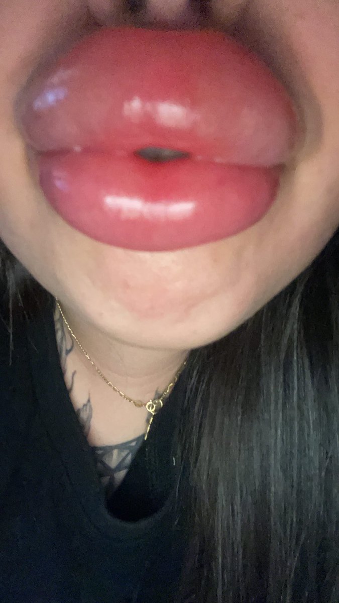 Lipaddictz's tweet photo. @christina_kaki Beautiful fresh lips! ππ #fake #lips #lipinjections #plastic #swollen #lipgap #juvederm #filler #addict #lipfetish #plasticsurgery #plasticpositive https://t.co/Xf2zGRH608