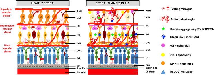 🆕Nueva publicación del equipo del <a href="/CastroviejoUCM/">Inst. Invest. Oftal. Ramon Castroviejo</a>. 
“Retinal Disorders in Humans and Experimental ALS Models” en <a href="/IntechOpen/">IntechOpen</a> 

Disponible online en: intechopen.com/online-first/8…