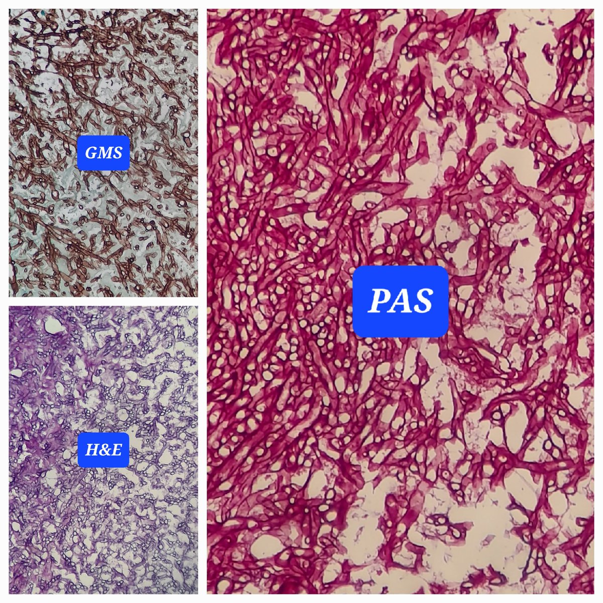 Cavitatory lesion in lung #pulmpath #lungpath @smlungpathguy @Path_Matt @seyma_buyucek @VijayPatho @adi_agnihotri @pembeoltulu @DrGeeONE @njayaram1959 @dr_amenona @padmapathology1 @LakshmiKoulmane @DrVasudevPrabhu @Swathiprabhu5 @rdpatho @ChristinaGoveas #PathTwitter #pathspotter