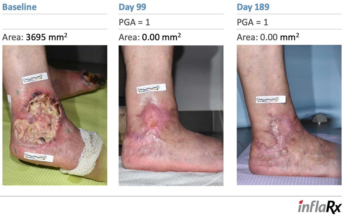 O248528307's tweet image. Pyoderma Gangrenosum (PG) an autoimmune condition with high unmet need. Orphan drug and fast track status granted. Awaiting feedback from FDA related to a P3 study. Imagine the pain day 1 and the improvement of life quality day 189. $IFRX