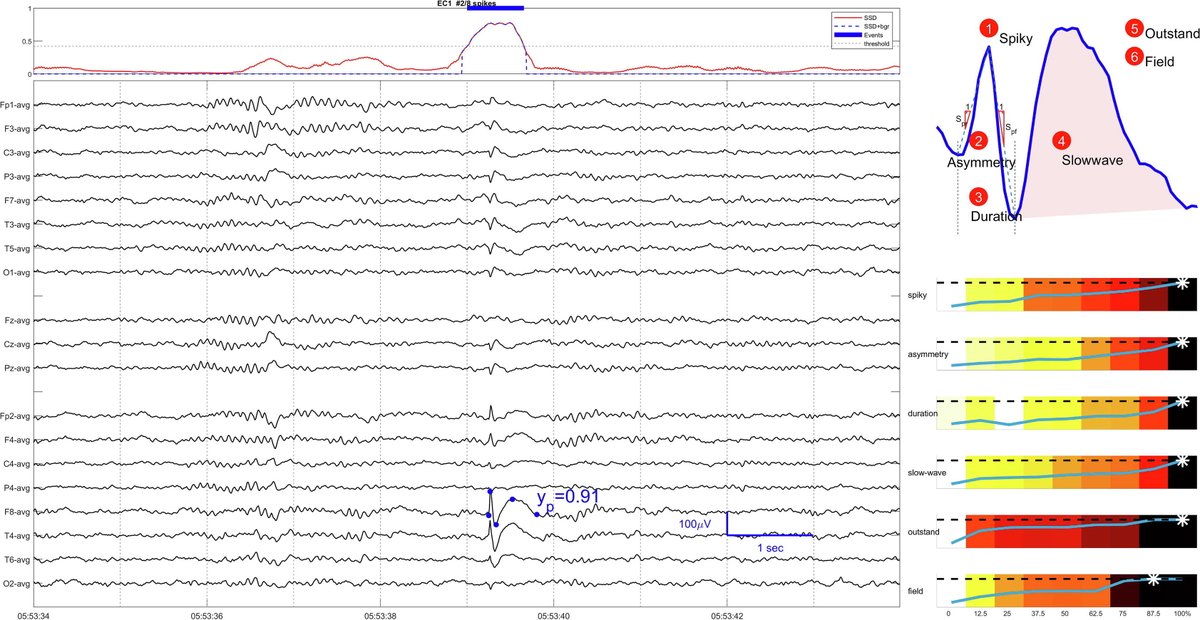 fabnascimen's tweet photo. We created an automated algorithm that quantifies the six #IFCN criteria for IED identification &amp; accurately captures the likelihood that a waveform is epileptiform, in a user-friendly way👇. @zhdylovejj @BrandonWestove5 @ClinicalNeuroph @EEGTalk 

https://t.co/qPpY0SI6QU https://t.co/76VpqG6Alo