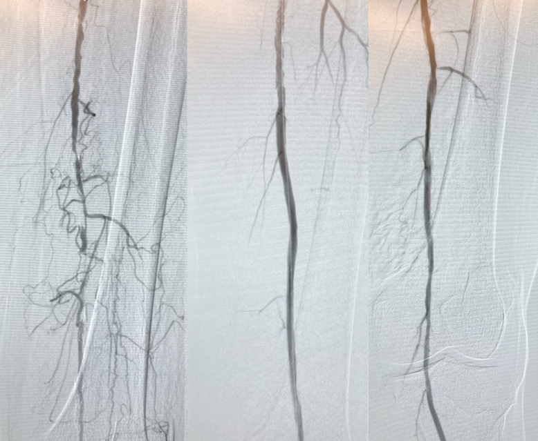 ShockwaveIVL's tweet photo. When treating a 71-year-old patient with rest pain, Dr. @MorrisSasson at @CleveClinicFL successfully used #ShockwaveIVL to treat a calcified SFA. Nine cycles of #ShockwaveM5Plus later, Dr. Sasson gained a beautiful restoration of flow.

ISI https://t.co/sZ0NdzXNcV #vasctwitter https://t.co/xVkiJLZH6k