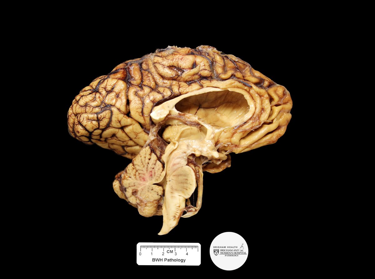 Hello and welcome to the Gross Case of the Week – Neuro Winter Edition! This week we have another case from autopsy. Can you guess what is pictured here? #GrossCOTW #NeuroWinter