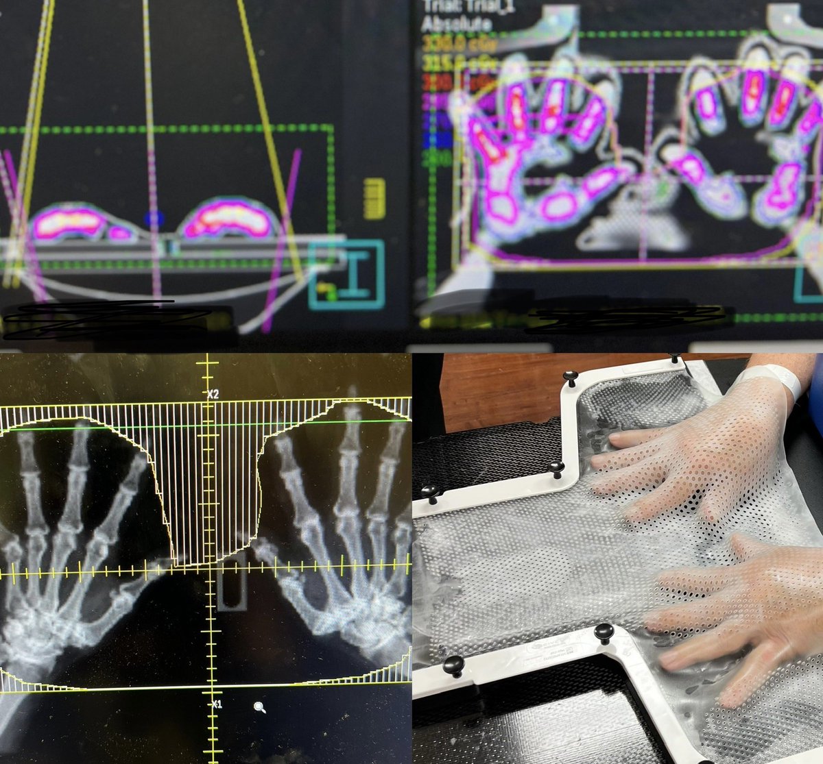 Bobby Koneru MD On Twitter We Planned And Treated Our First Bobby koneru md on twitter we planned and treated our first