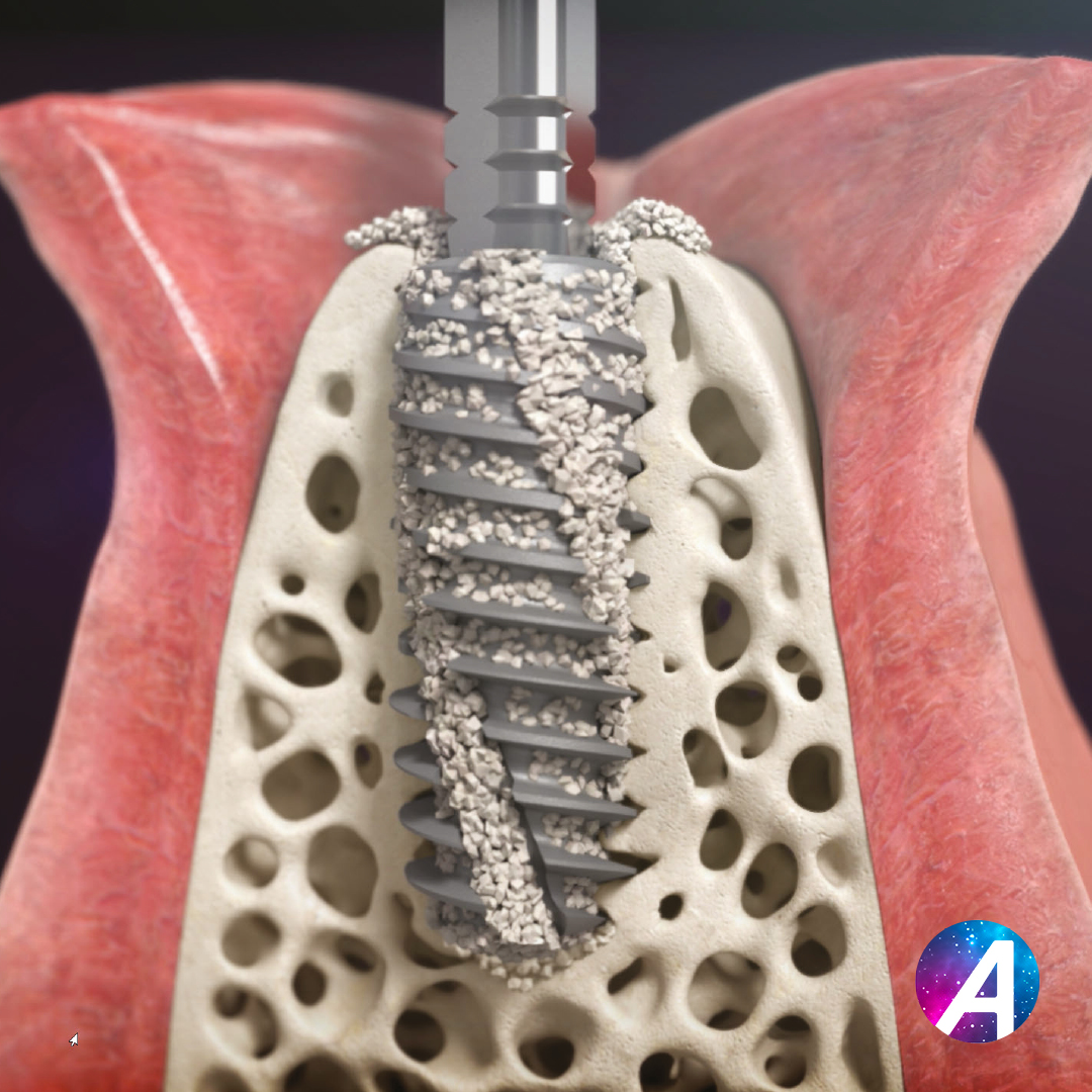 Avec le lancement d'AxiomX3, c’est un nouveau pas décisif qu’Anthogyr fait pour répondre aux exigences de l’#implantologie moderne. Quintessence de notre savoir-faire, elle place la préservation osseuse au coeur de la pratique. 

INSIDE Magazine➡️bit.ly/InsideAnthogyr