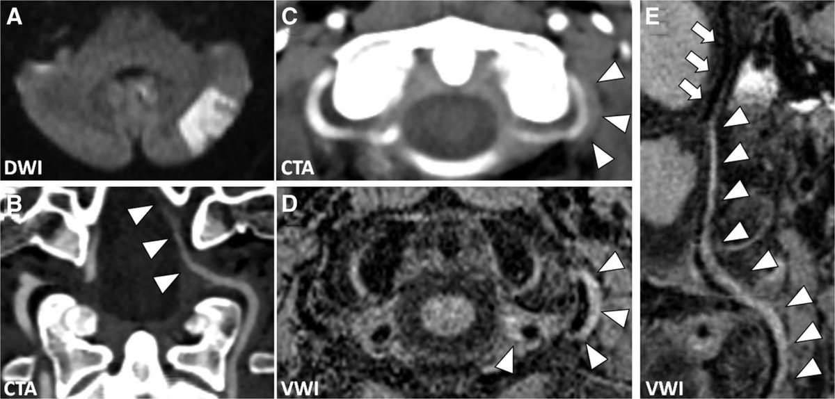 Stroke AHA ASA On Twitter STROKE StrokeImages Vessel Wall MRI For Stroke aha asa on twitter stroke strokeimages vessel wall mri for