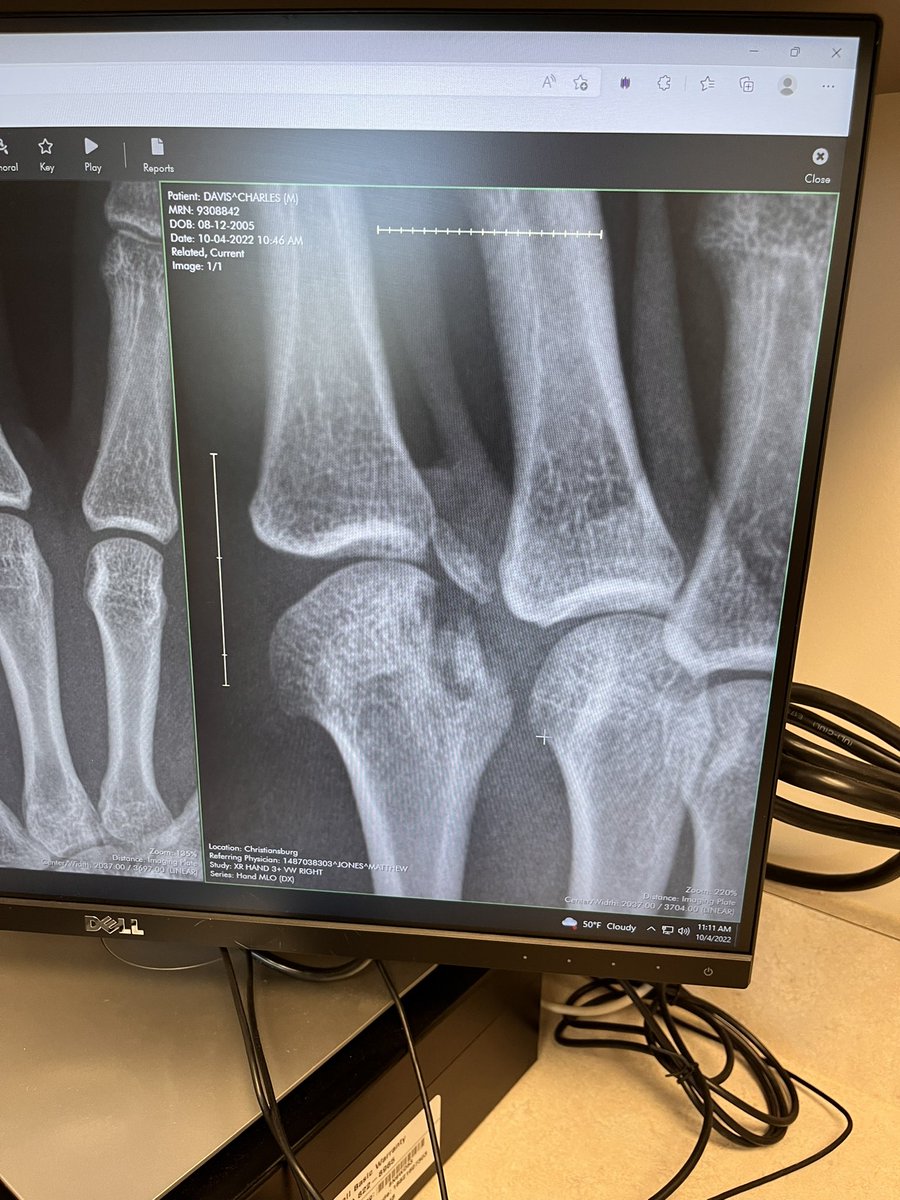 cmdavis50's tweet photo. Had to fix some injuries from this past season. Time to recover and come back even stronger 💪🏻💪🏻 https://t.co/2tPhM1vOjJ