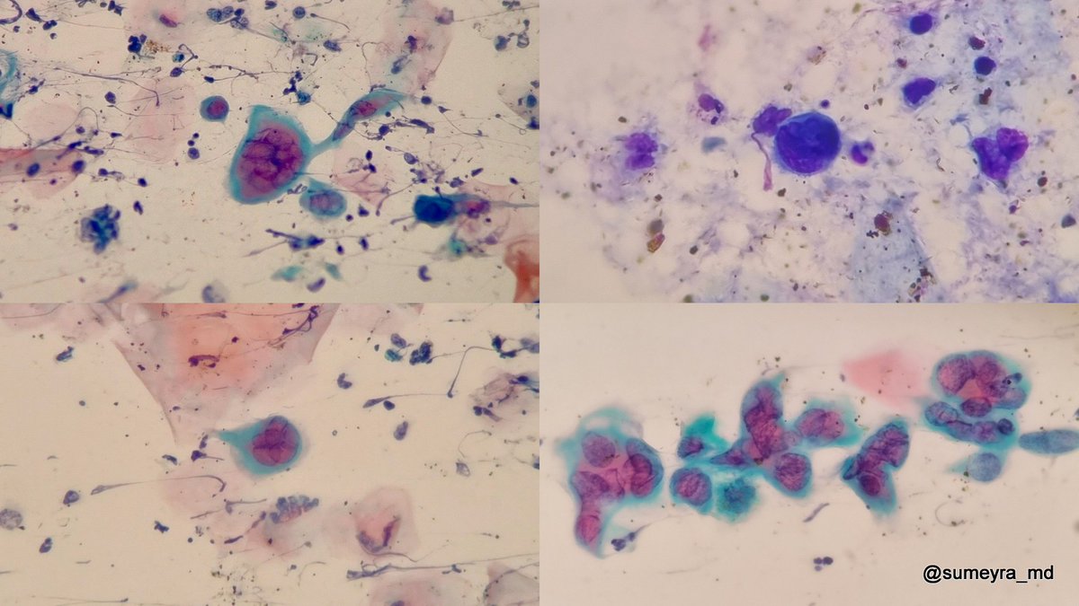 Oral herpes, Pap and MGG stain🌸
#PathTwitter #cytopath #MedEd #IDPath #pathresidents
